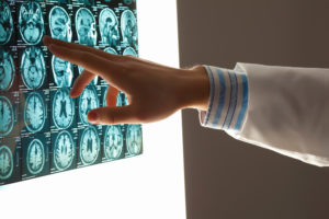 personal injury law - brain injuries - brain death